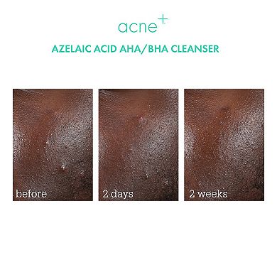 Mini Acne+ 2% BHA + Azelaic Acid + Niacinamide + AHA Cleanser