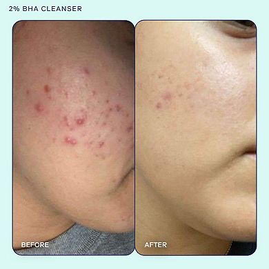 Mini Acne+ 2% BHA + Azelaic Acid + Niacinamide + AHA Cleanser