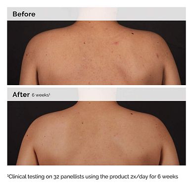 Salicylic Acid 0.5% Body Serum Exfoliating Treatment for Acne