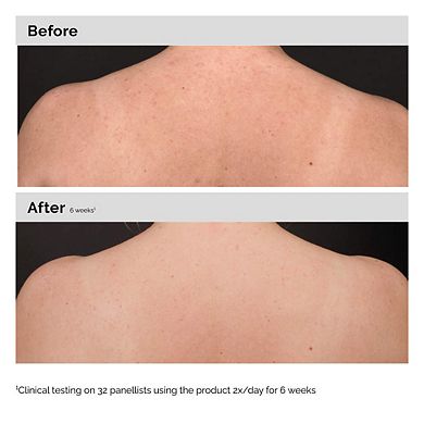 Salicylic Acid 0.5% Body Serum Exfoliating Treatment for Acne