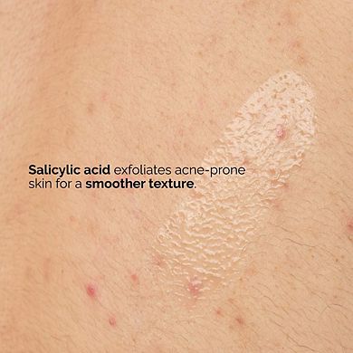 Salicylic Acid 0.5% Body Serum Exfoliating Treatment for Acne