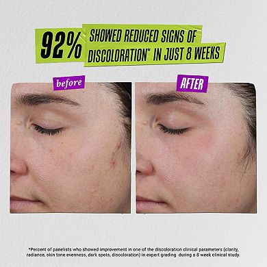 Auto-Tone Skin Discoloration Treatment with SPF 30