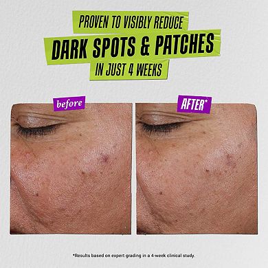Auto-Tone Skin Discoloration Treatment with SPF 30