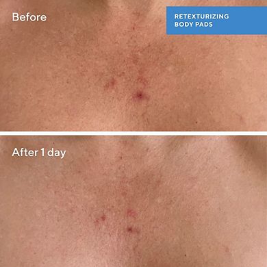 Retexturizing Body Pads with Salicylic Acid
