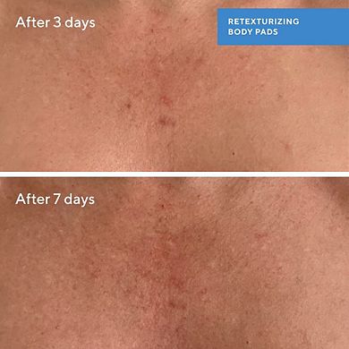 Retexturizing Body Pads with Salicylic Acid