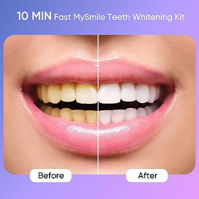 Mysmile Ultimate 35% Carbamide Peroxide Teeth Whitening Kit