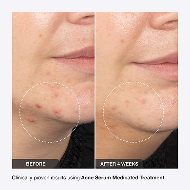iNNBEAUTY PROJECT Acne Serum Medicated Treatment for Acne & Blackheads