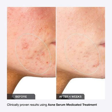 iNNBEAUTY PROJECT Acne Serum Medicated Treatment for Acne & Blackheads