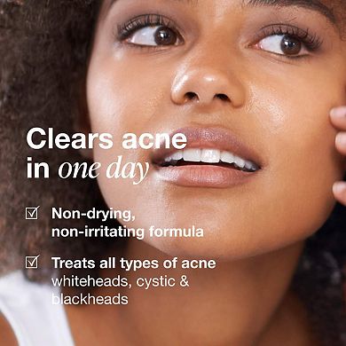 Acne Serum Medicated Treatment for Acne & Blackheads