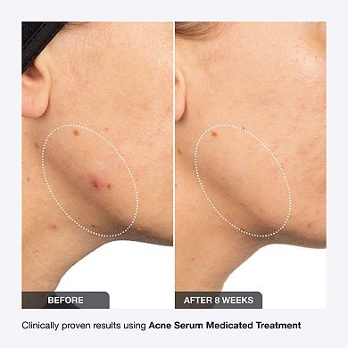 Acne Serum Medicated Treatment for Acne & Blackheads