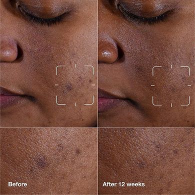 Even Better Clinical Dark Spot Clearing Serum with Vitamin C