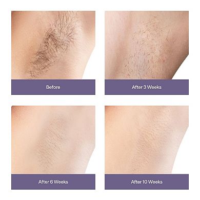 Ulike Ice Cooling At-Home Hair Removal Device