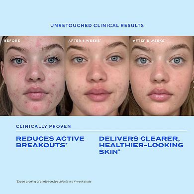 Biome-Balancing Clear & Prevent Acne Treatment Serum