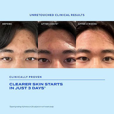 Biome-Balancing Clear & Prevent Acne Treatment Serum