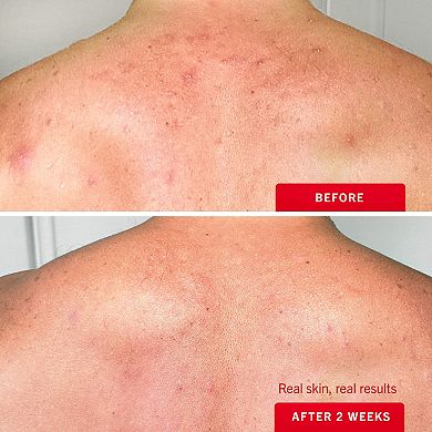 Body Acne Clearing Mist - 2% Salicylic Acid Acne Treatment