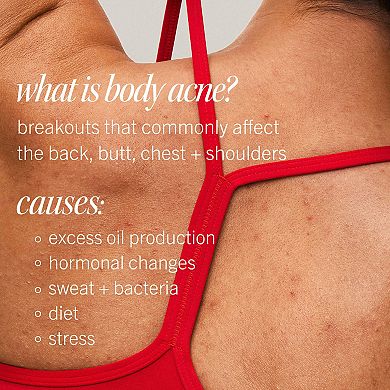 Body Acne Clearing Mist - 2% Salicylic Acid Acne Treatment