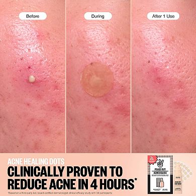 Acne Healing Dots Mega Value Set with Full-Size Acne Serum