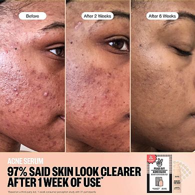 Acne Healing Dots Mega Value Set with Full-Size Acne Serum