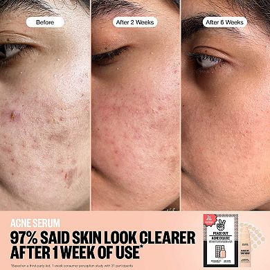 Acne Healing Dots Mega Value Set with Full-Size Acne Serum
