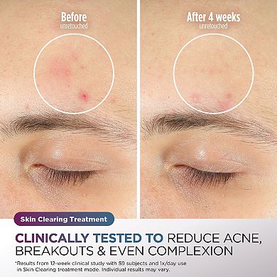 Shark® CryoGlow™ Under-Eye Cooling Face Mask