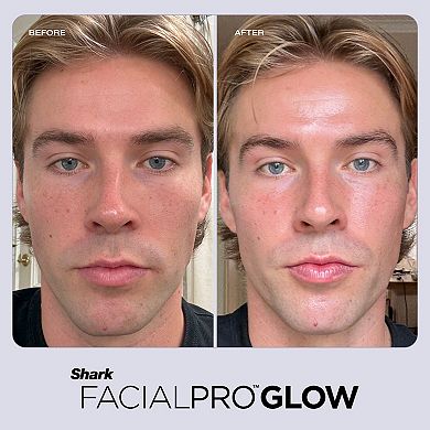 Shark® FacialPro Glow At Home Hydro-Powered System