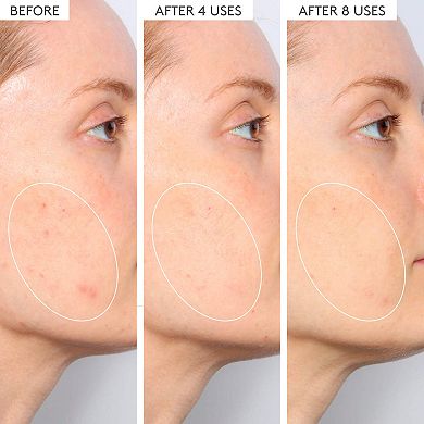 TLC Sukari Babyfacial 25% AHA/ 2% BHA Exfoliating Mask