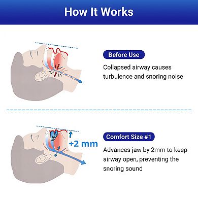 YEVYO Anti-Snoring Mouthpiece,Mouth Guard with +2mm Jaw Adjustment, Breathable Anti Snoring Solution