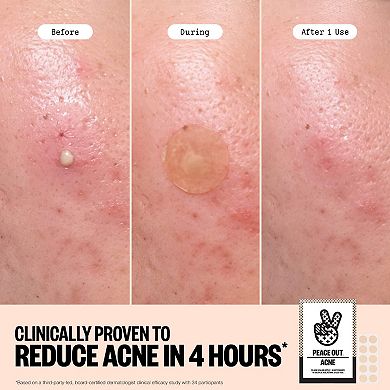 Mega Acne Dot Duo Kit With Salicylic Acid