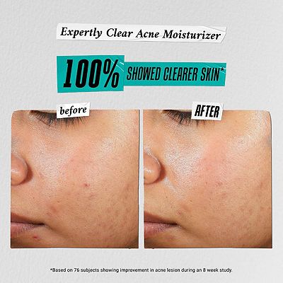 Kiehl's Since 1851 Ditch The Zituation Gift Set for Acne-Prone Skin